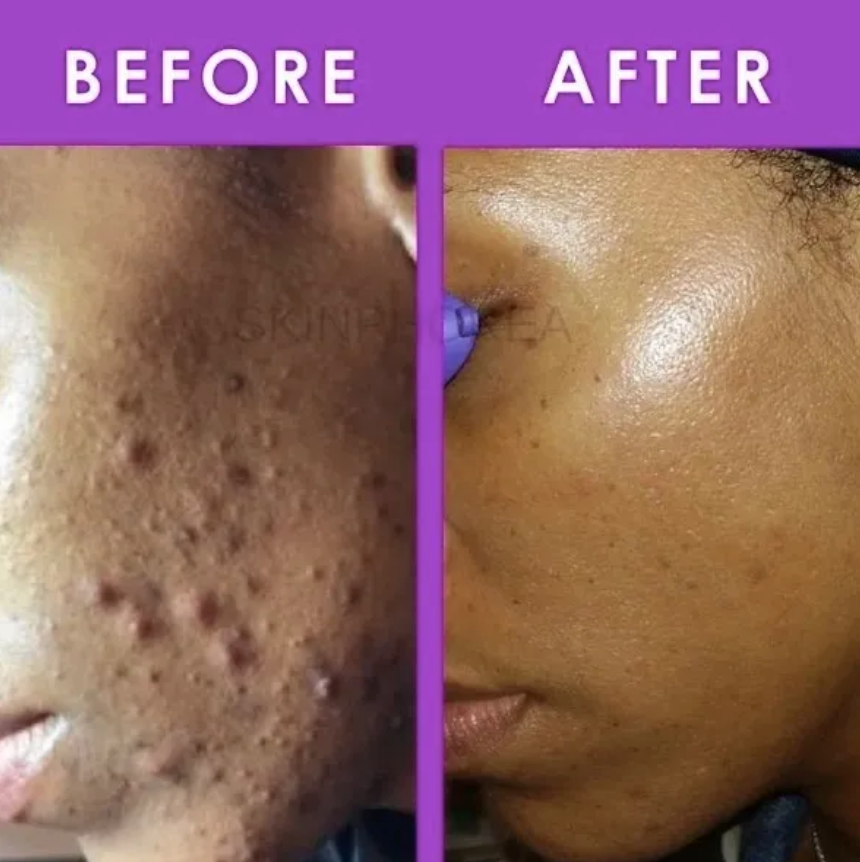 Inflamed Acne Kit