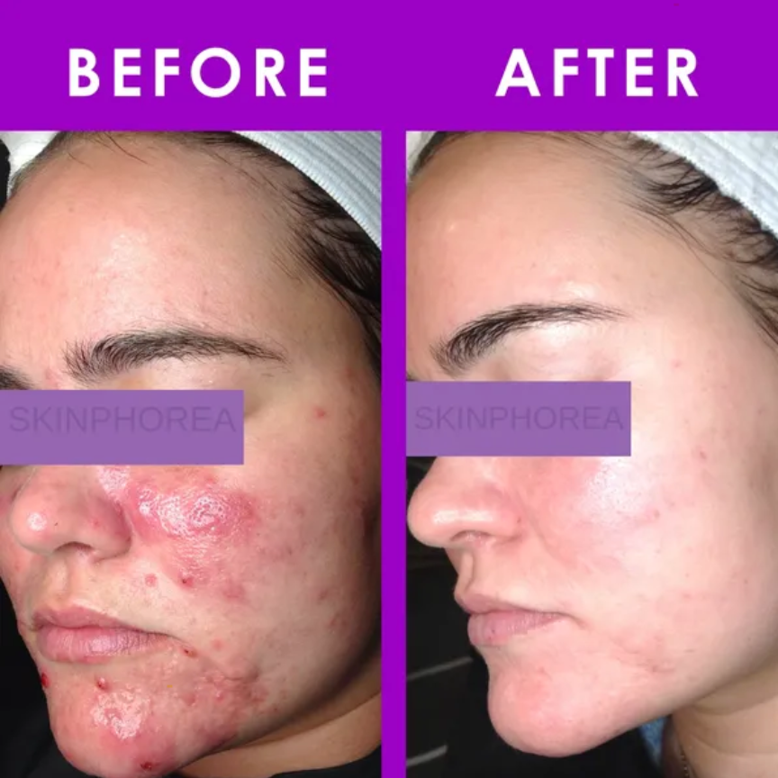 Inflamed Acne Kit